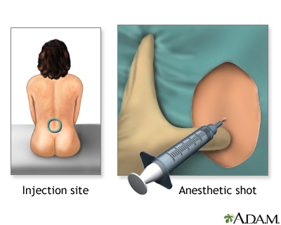 Epidural steroid injection pictures