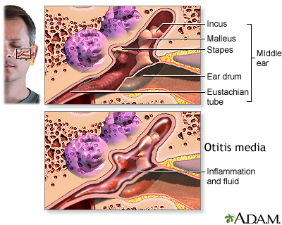Middle ear infection (otitis media)
