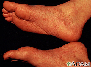 Reactive arthritis - view of the feet