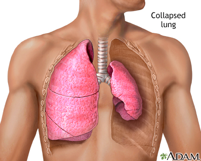 Collapsed lung, pneumothorax