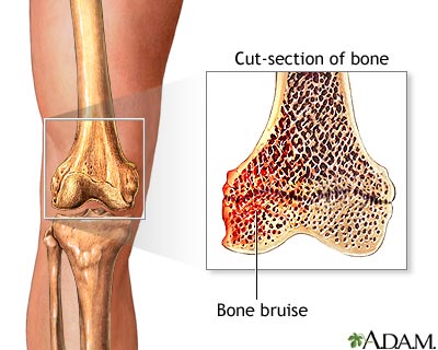 Bone bruise