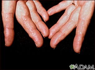 Amyloidosis on the fingers