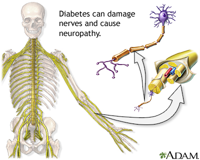 Diabetes and nerve damage