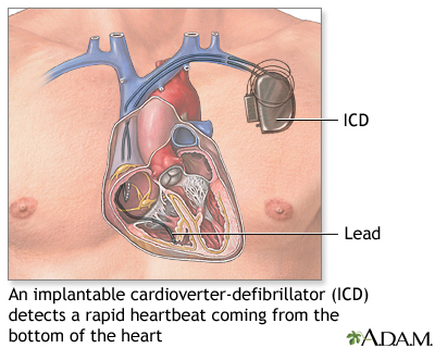 Implantable cardioverter-defibrillator