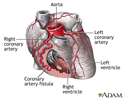 Coronary artery fistula