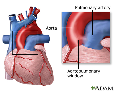 Aortopulmonary window