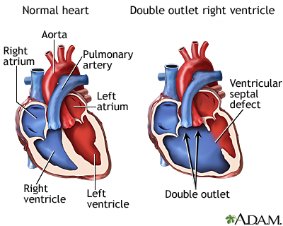 Double outlet right ventricle