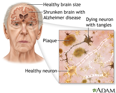 What is Alzheimers Disease? | CDC