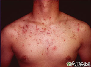 Acne, cystic on the chest