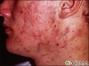 Acne, cystic on the face