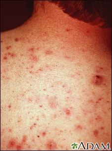 Acne, vulgaris on the back