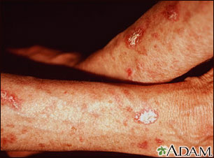 Actinic keratosis on the forearms