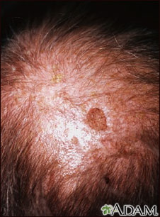 Actinic keratosis on the scalp
