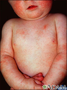 Dermatitis, atopic in an infant
