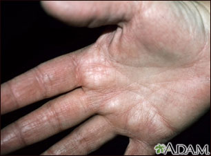 Hyperlinearity in atopic dermatitis, on the palm
