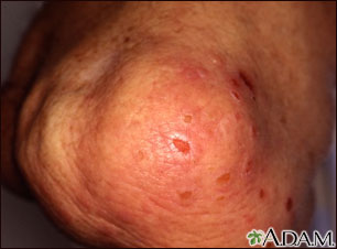 Dermatitis, herpetiformis on the knee