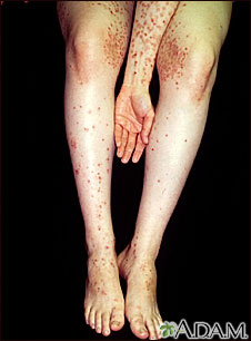 Dermatitis, herpetiformis on the arm and legs