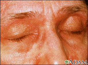 Dermatomyositis, heliotrope eyelids