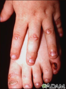 Epidermolysis bullosa, dominant dystrophic