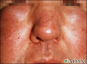 Edema, central on the face