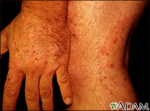 Ringworm, tinea on the hand and leg
