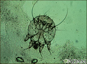 Scabies mite, photomicrograph