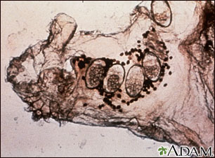 Scabies mite, eggs, and stool photomicrograph