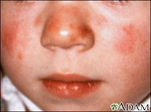 Lupus, discoid on a child's face