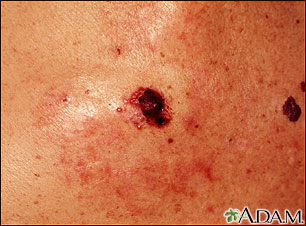 Skin cancer, close-up of level IV melanoma