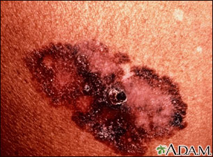 Skin cancer, melanoma superficial spreading