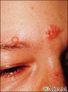 Sarcoidosis on the nose and forehead
