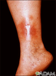 Dermatitis, stasis on the leg