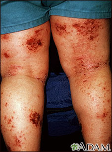 Dermatitis, atopic on the legs