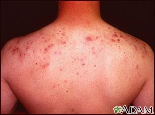 Acne, cystic on the back
