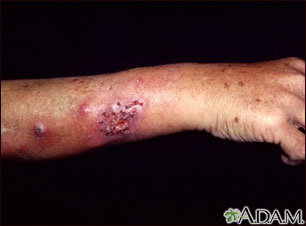 Sporotrichosis on the forearm