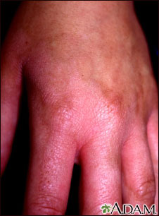 Phytophotodermatitis on the hand