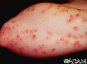 Dermatitis, herpetiformis on the forearm