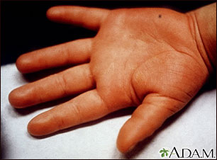 Kawasaki's disease - edema of the hand