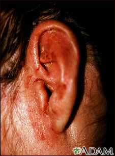 Tinea corporis - ear
