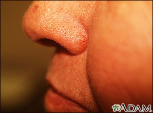 Basal cell carcinoma - nose