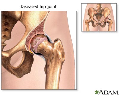 Diseased hip