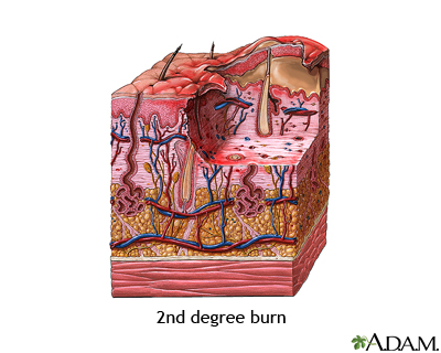 Second degree burn