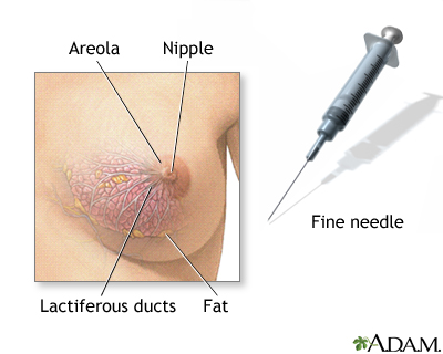 Female breast biopsy