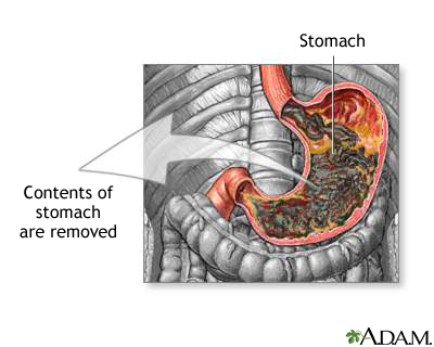 Gastric suction