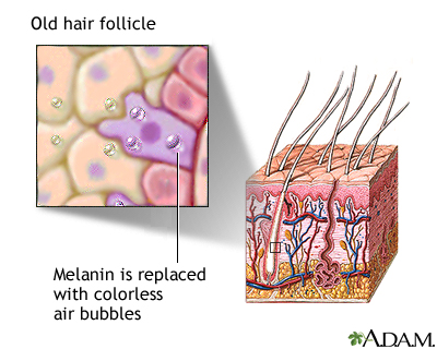 Aged hair follicle