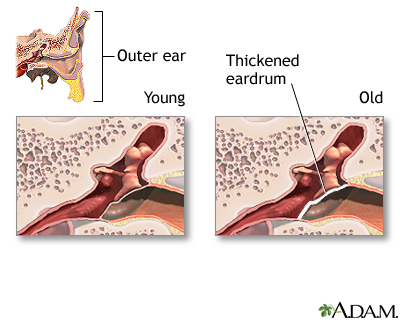 Aging changes in hearing