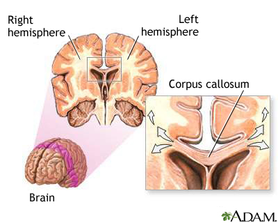 Corpus callosum of the brain