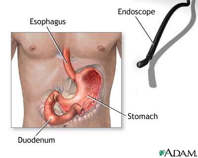 Gastric endoscopy