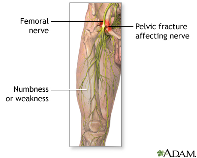 Femoral nerve damage