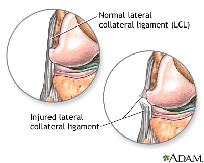 Torn lateral collateral ligament
